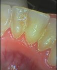 Zubní kámen na dolních řezácích a s tím spojený zánět dásní, vpravo po odstranění zubního kamene