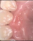 Čistý povrch zubů po odstranění pigmentací pomocí air-flow