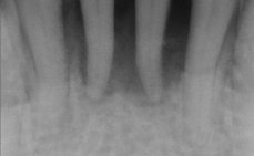 Úbytek kosti v oblasti dolních řezáků vlivem parodontitidy