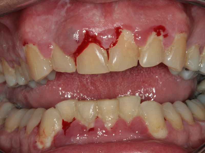 Masivní nánosy povlaku,zubního kamene a krvácení dásní, vpravo stav po dentální hygieně
