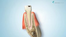 Jednoduchá extrakce zubu a následné zhojení rány